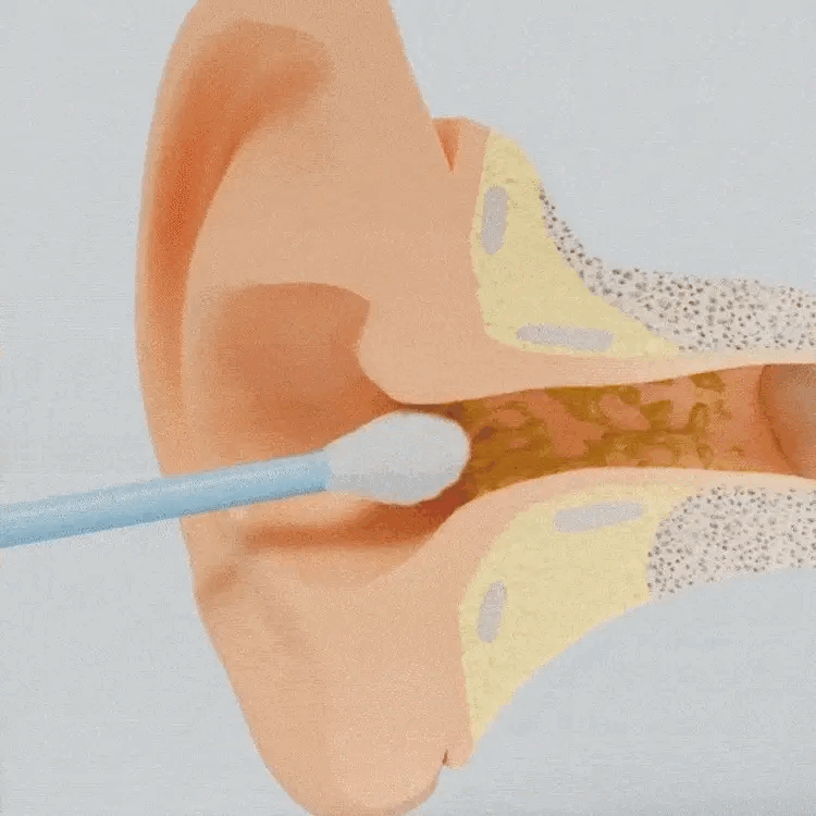 EarClean - Ear Wax Cleaning