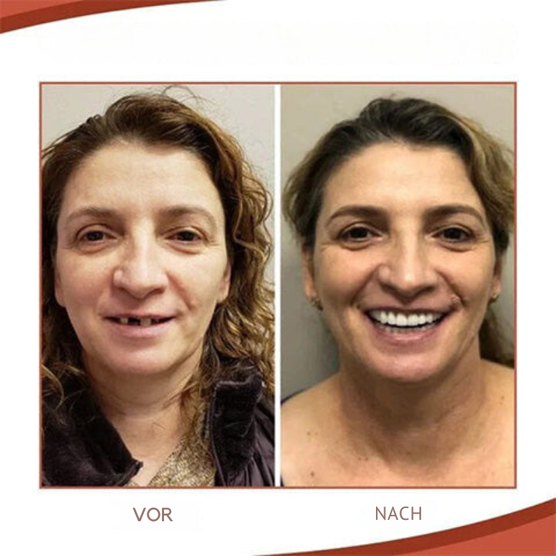 Nokmo | Biocompatible Prosthesis Set for Pain-Free Fit and Natural Smile