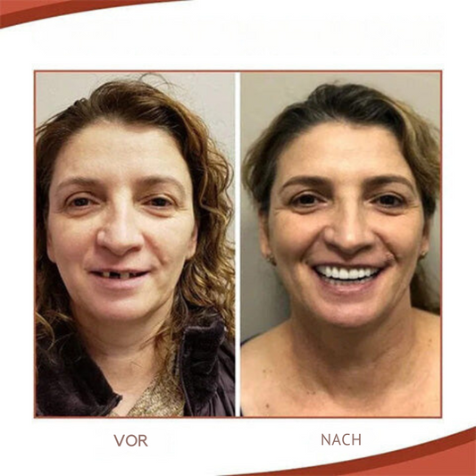 Nokmo | Biocompatible Prosthesis Set for Pain-Free Fit and Natural Smile