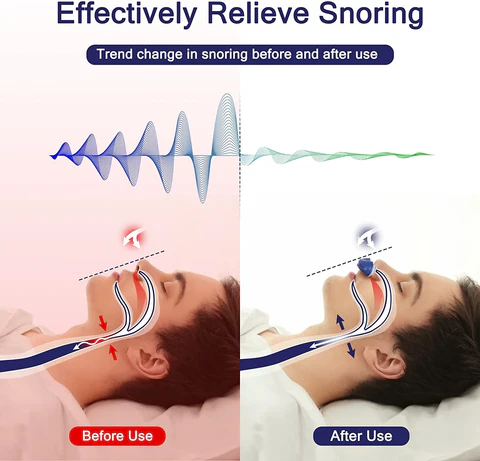 Nokmo | Micro CPAP Sleep Apnea Machine for Travel and Anti-Snoring - CPAP Alternative