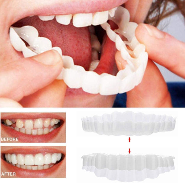 Nokmo | On Smile Veneers (Upper and Lower Jaw Included)