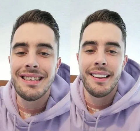 Nokmo | On Smile Veneers (Upper and Lower Jaw Included)