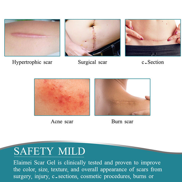 Nokmo | Silicone Scar Tape Roll
