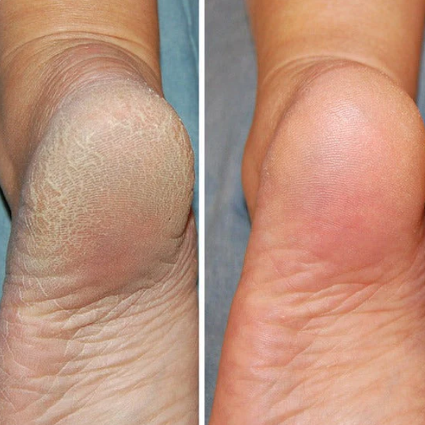 Silicone Spa Socks - Intensive Care for Cracked and Tired Feet
